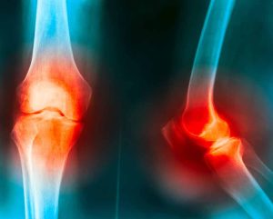 Osteoarthritis of the Knee