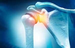 Recent Physician-led Lecture Focuses on “Advancements in the Treatment of Rotator Cuff Tears”