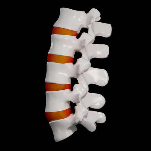 Is My Back Pain Caused by a Pinched Nerve or Degenerated Disc?